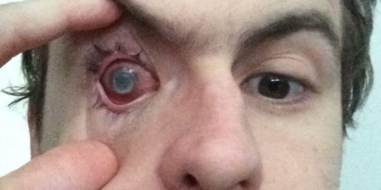 Man blinded by parasite after showering with contacts in