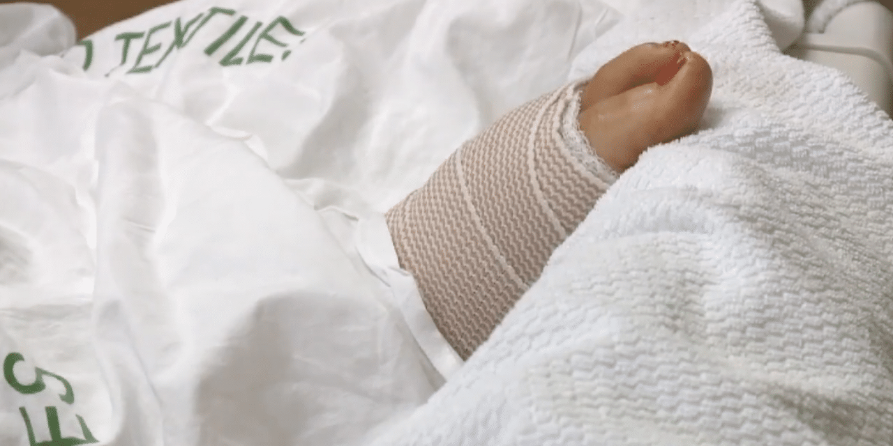 California woman’s foot ravaged by flesh-eating bacteria, exposing her bones