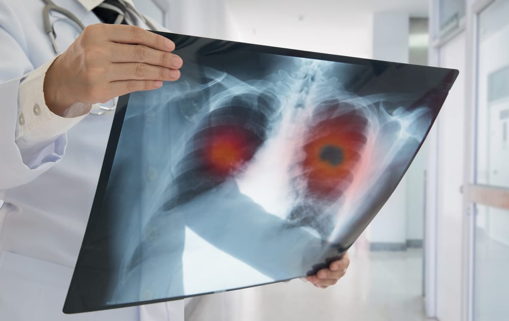 MYSTERY: Growing lung cancer cases — turning up in unexpected population…