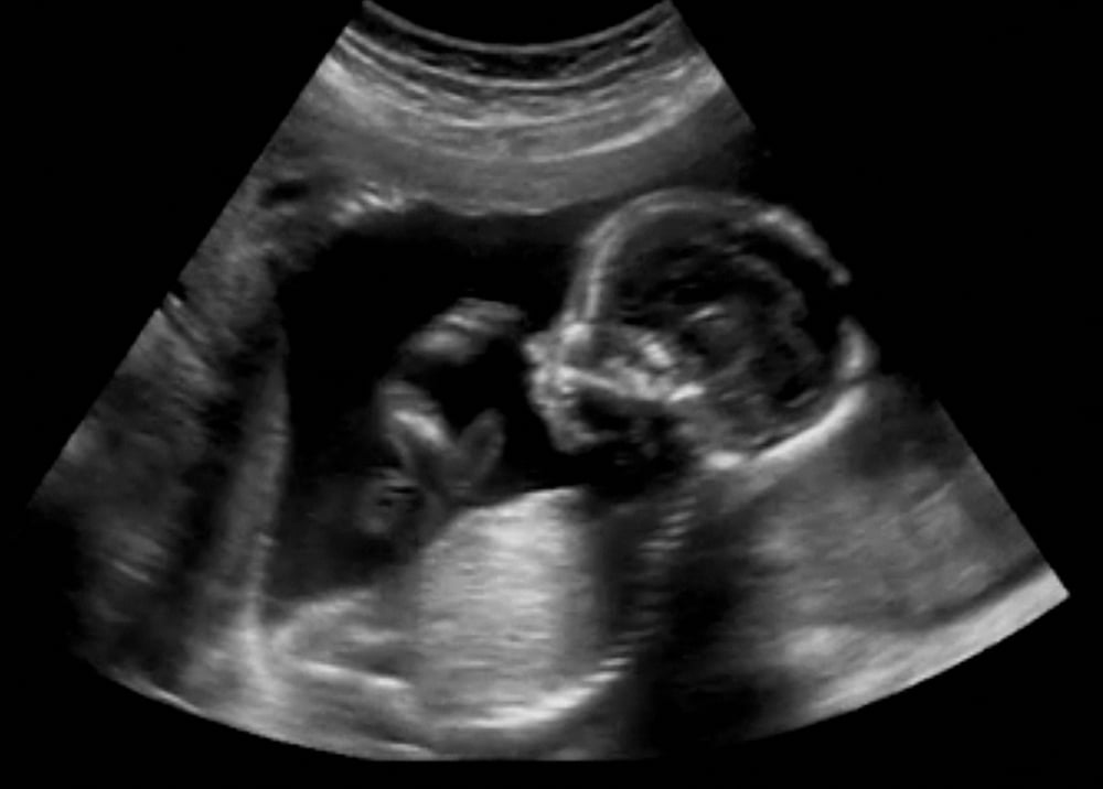 Obstetric,Ultrasonography,Ultrasound,Echography,Of,A,Fourth,Month,Fetus ...