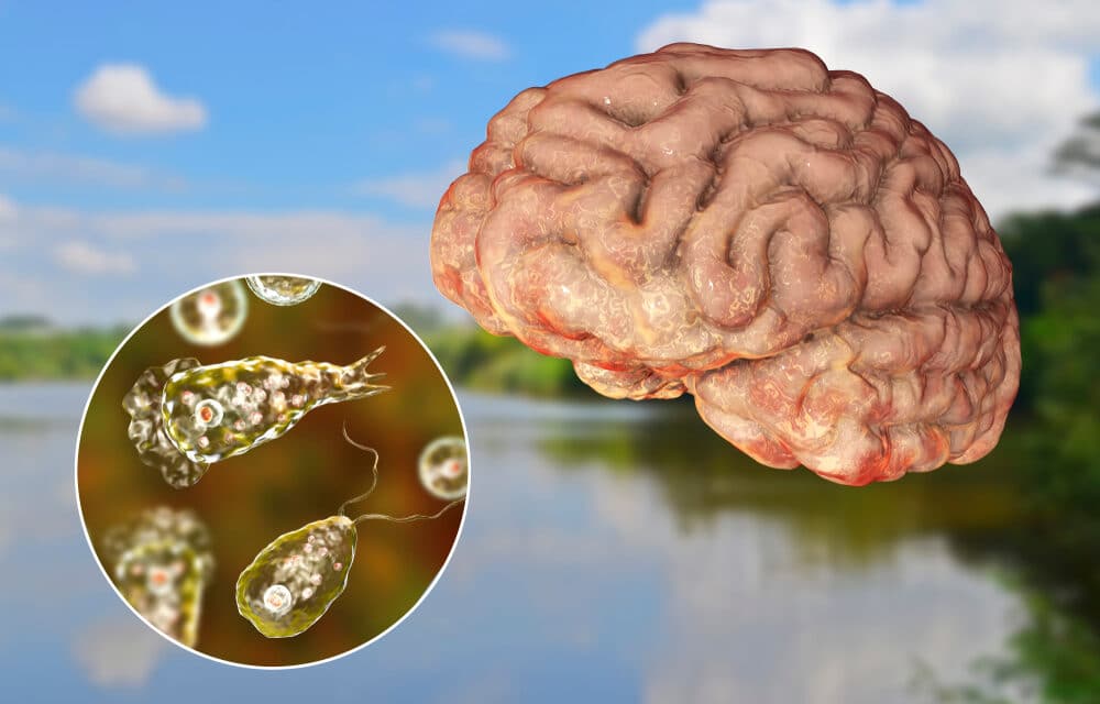 Brain eating amoeba appears to be spreading North across the U.S.