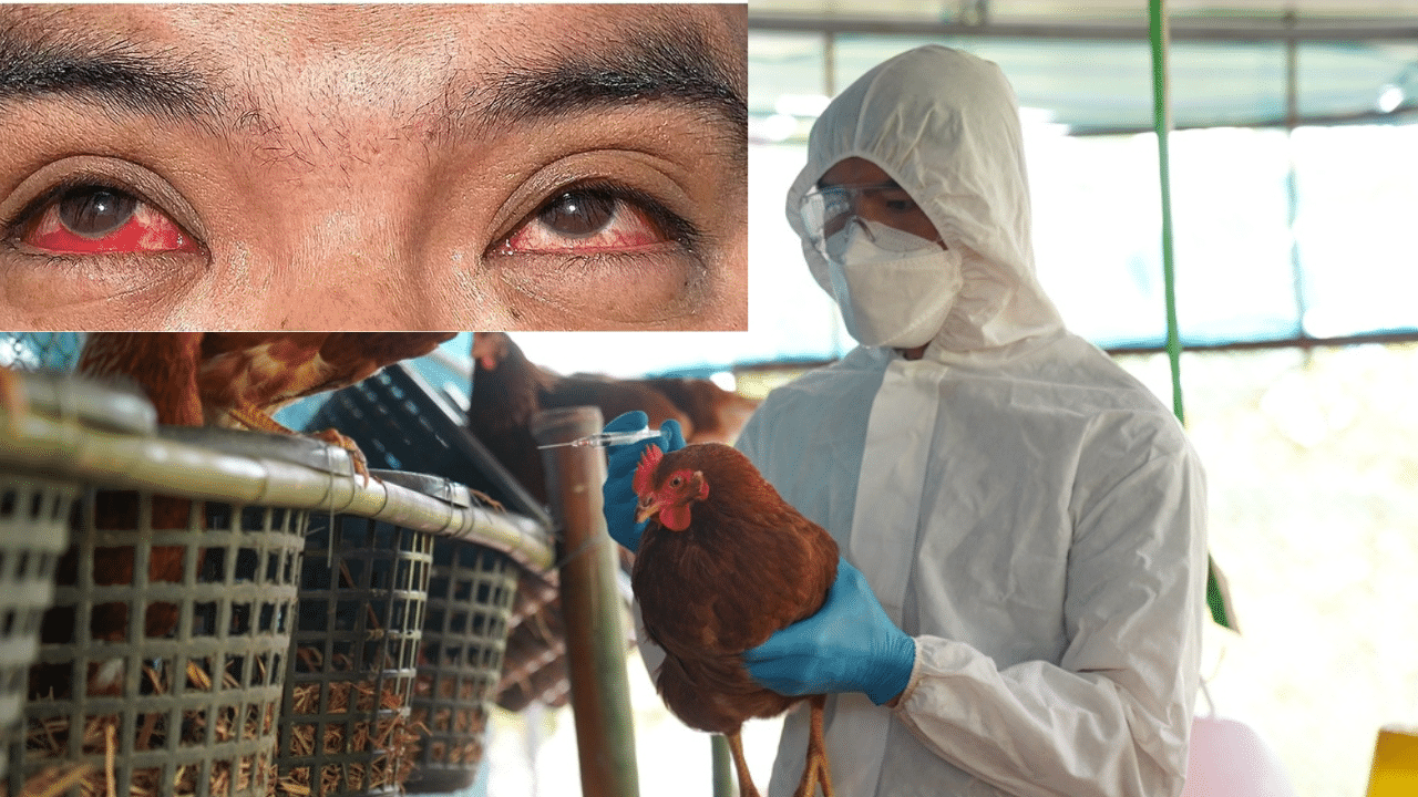 Photos of Texas farm worker who caught bird flu shows bleeding in eyeballs