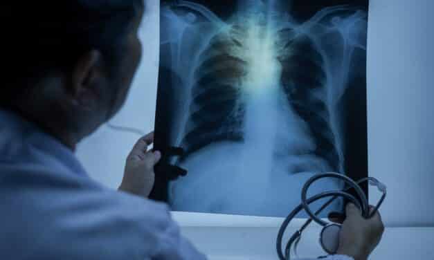 Young and middle-aged American women are being diagnosed with lung cancer at higher rates than men