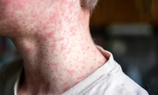 At least 62 Israelis infected with measles amid outbreak