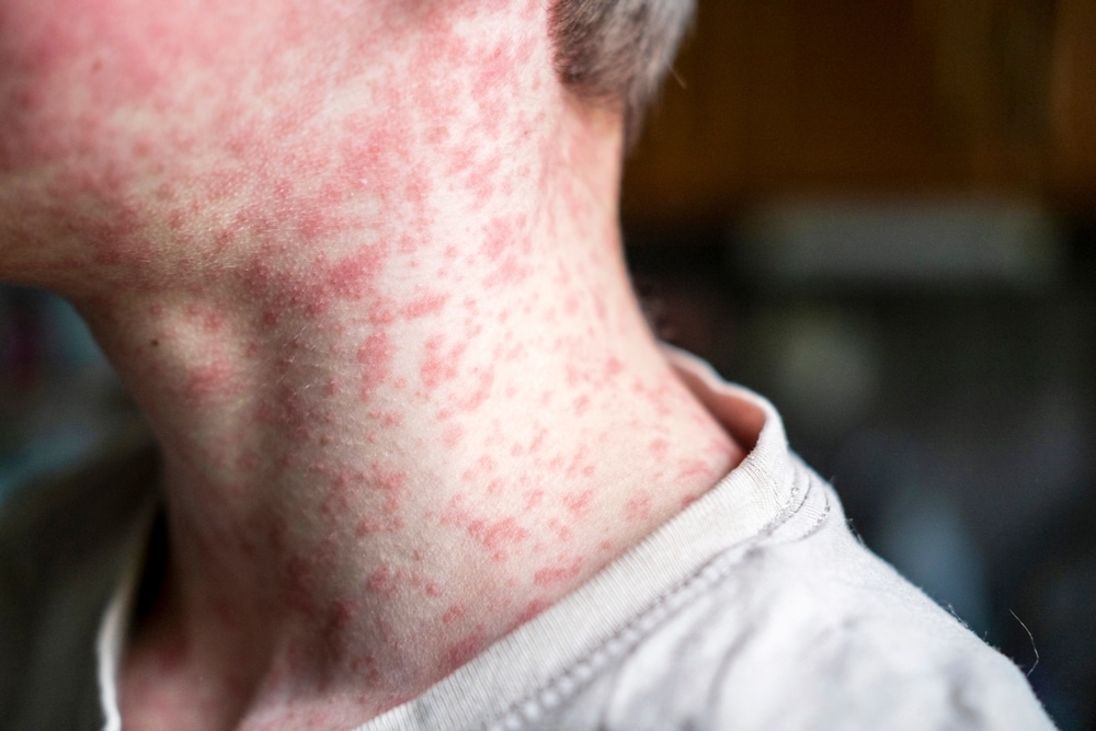 At least 62 Israelis infected with measles amid outbreak